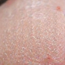 Collagen fibers in skin